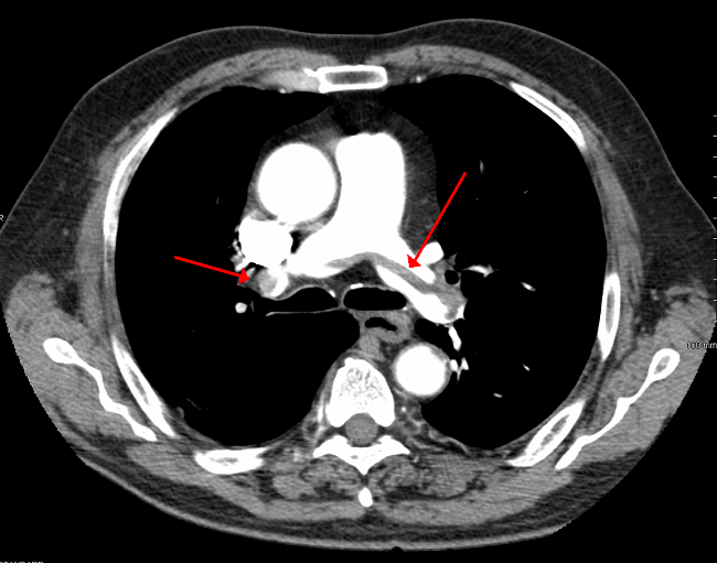 bilateral pulmonary embolisms